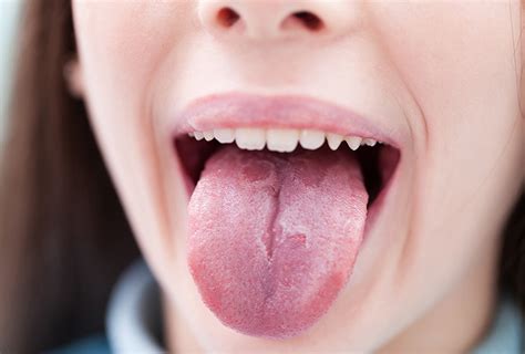 Home Remedies For A Sore Tongue Top 10 Home Remedies