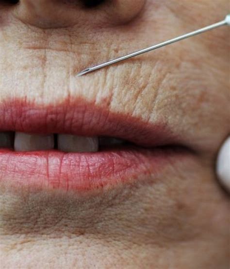 Solutions For Smoker S Lines And Wrinkles Around Lips Dr Kally