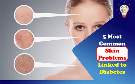 5 Most Common Skin Problems Linked To Diabetes Updated Ideas