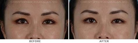 Fillers To Upper Lids Before And After Photo Gallery