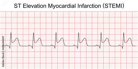 Electrocardiogram Show St Elevation Myocardial Infarction Stemi