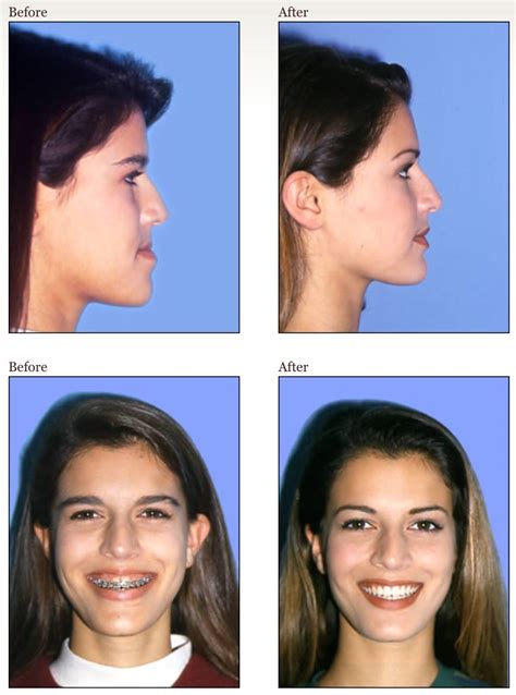 Braces Jaw Overbite Before And After Before And After