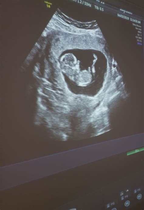 9 Weeks Pregnant 3d Ultrasound