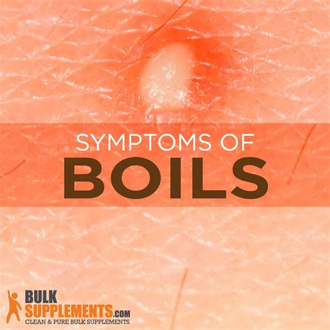 Boils Symptoms Causes And Treatment By James