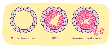 Dcis Ductal Carcinoma In Situ Explained Breast Cancer Now