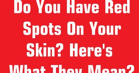 Do You Have Red Spots On Your Skin Heres What They Mean Krobknea