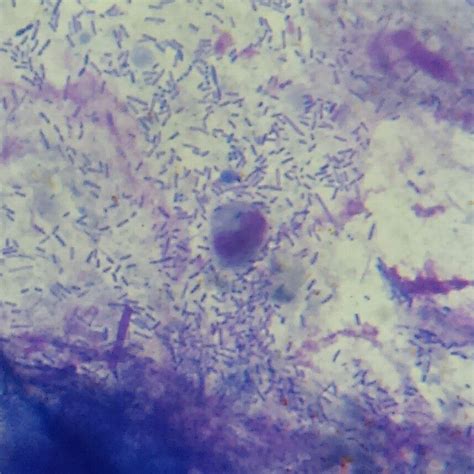 Wbc In Stool Mononuclear Cell Medical Laboratory Scientist Wbc