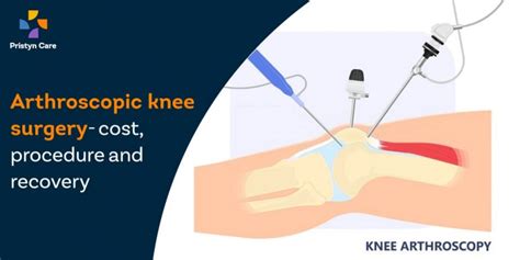 Arthroscopic Knee Surgery Cost Procedure And Recovery Pristyn Care