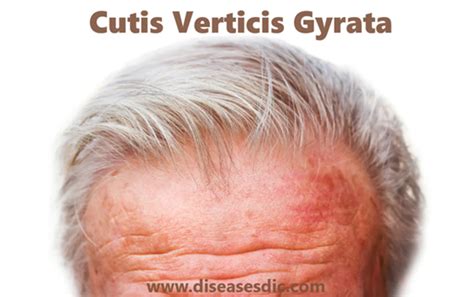 Cutis Verticis Gyrata Cvg Classification Causes And Treatment