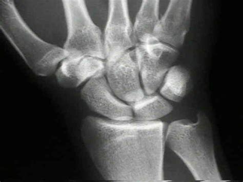 Scaphoid Fracture Causes Symptoms Diagnosis And Treatment