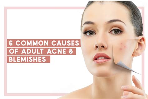 6 Common Causes Of Adult Acne And Blemishes Lux Medical Aesthetic Clinic