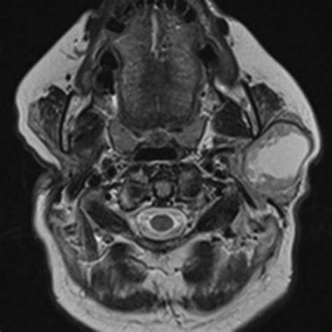 Ct Head And Neck Showing Enlarged Right Parotid Gland With Mandibular
