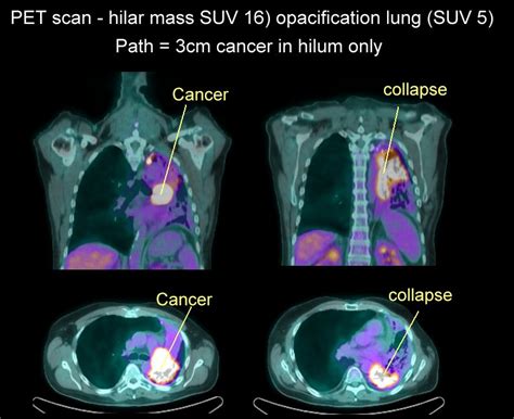 Xrays And CT Scans Of Lung Cancer