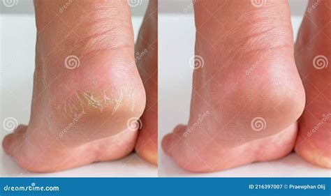 Image Before And After Treatment Of Dry Heels Cracks Skin Dehydrated