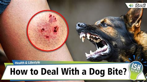 How To Deal With A Dog Bite Ish News Youtube