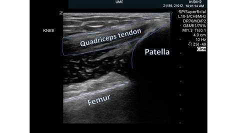 US Pre Patellar Bursitis Ultrasound Of The Month Taming The SRU