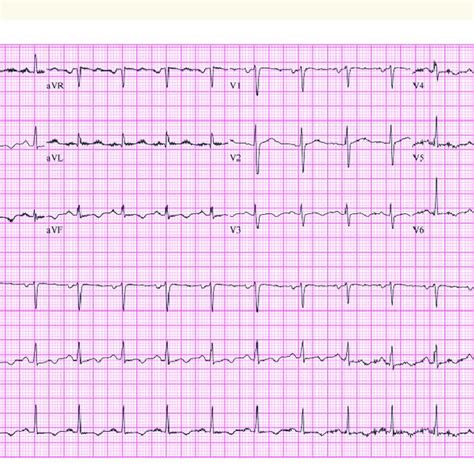 Twelve Lead Electrocardiogram Post Implantable Cardioverter