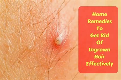 23 Home Remedies To Get Rid Of Ingrown Hair Effectively Wellnessguide