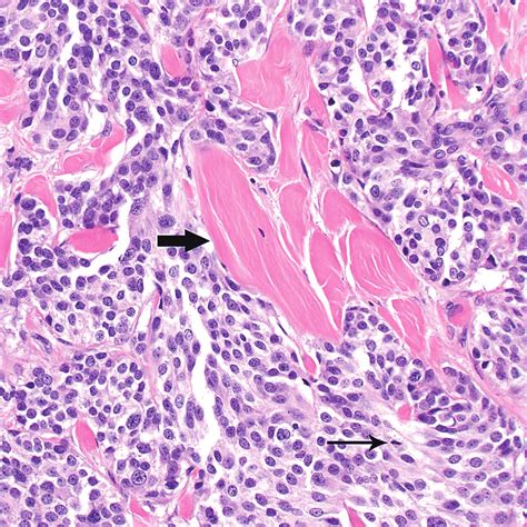 Medullary Thyroid Carcinoma Metastatic To The Skin And Subcutaneous
