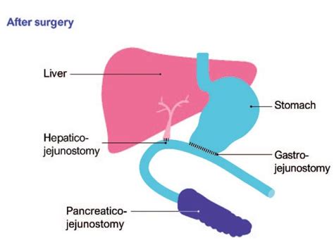Perioperative Management And Anaesthetic Considerations For Pancreatic
