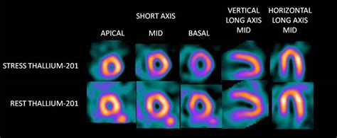 Info about the element thallium includes the definition, classification, history, discovery, properties,use and occurrence. Thallium-201 for Myocardial Perfusion Imaging | Lantheus