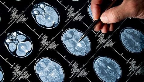 Researchers Report Mixed Results For Alzheimers Drug Lmtm