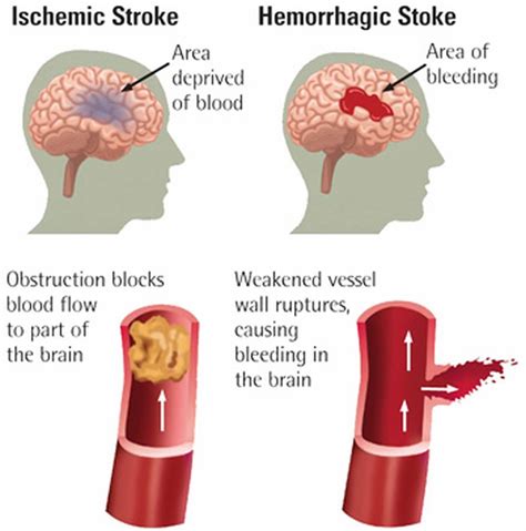 Ischemic Stroke Causes Signs Symptoms Ischemic Stroke Treatment