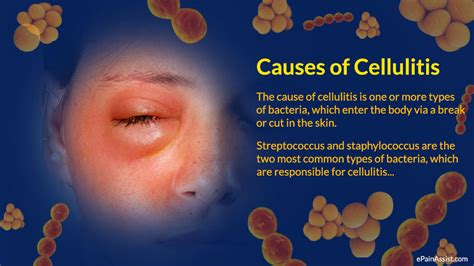 Cellulitis Infections Apex Dermatology And Skin Surgery