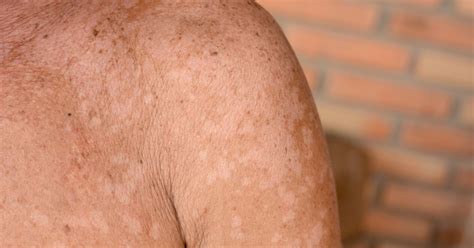 Symptoms And Treatments Of Pityriasis Versicolor Facty Health