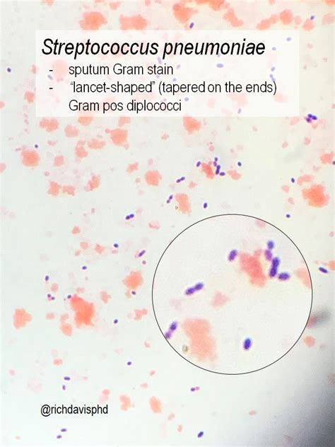 Gram Negative Diplococci In Sputum