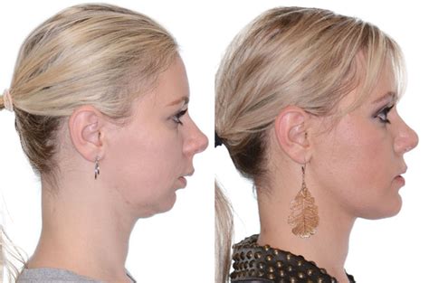 Corrective Jaw Surgery Complete Face Makeover Corrective Jaw Surgery