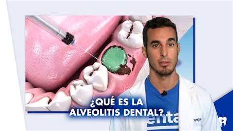 1 ¿qué Es La Alveolitis Dental Y Qué Tipos Existen La Alveolitis Dental Es Una Infección