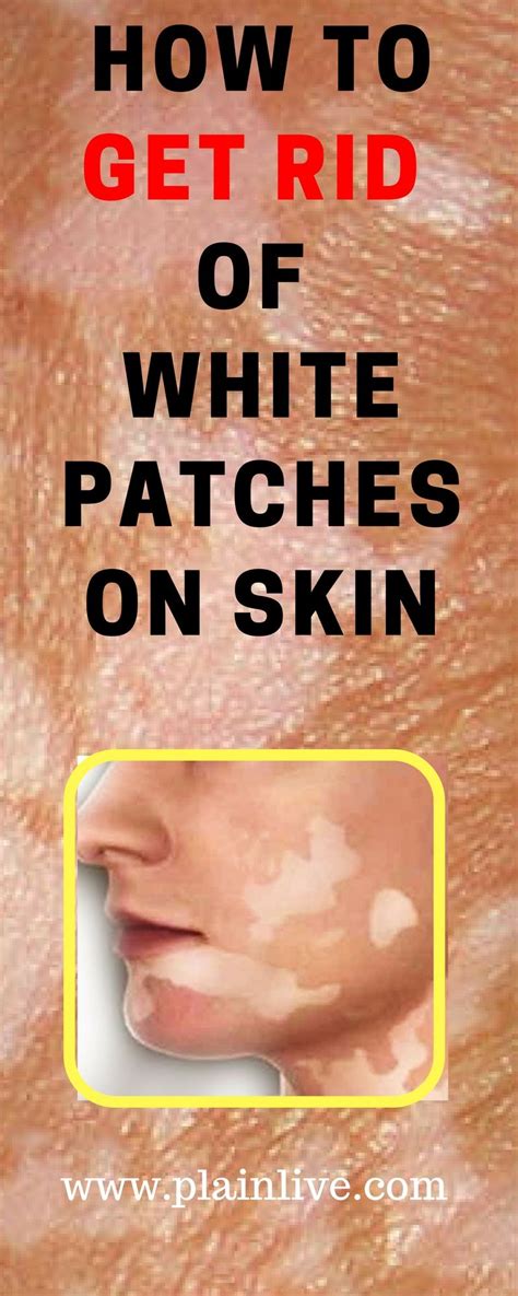 How To Get Rid Of White Patches On Skin White Skin Patches White