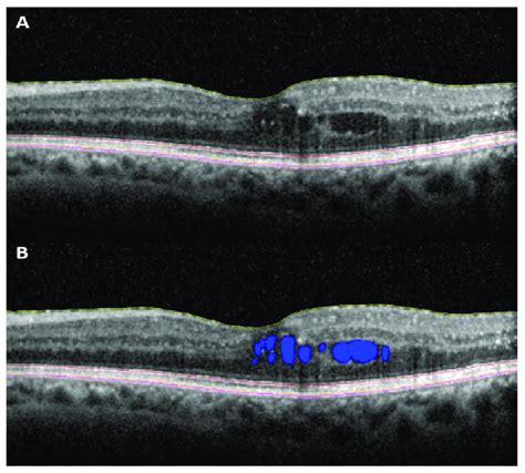 Spectral Domain OCT Scan Of A Patient With Diabetic Macular Edema A Download Scientific