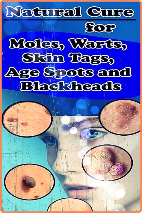 7 easy ways to remove skin tags without visiting a doctor kikotest medium