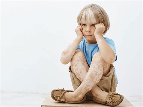 Causes And Treatment Of Vitiligo In Children Dr Kalko