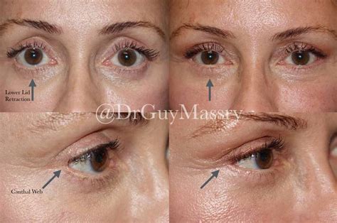 Blepharoplasty Beverly Hills Ca Cosmetic Eyelid Surgery Beverly Hills Ca