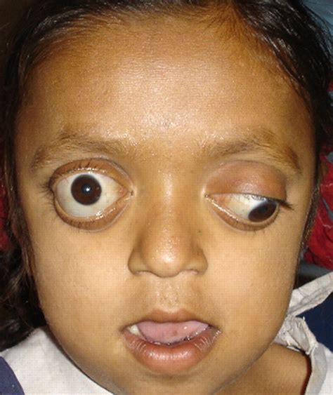 Crouzon syndrome | BMJ Case Reports