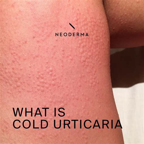 What Is Cold Urticaria Neoderma