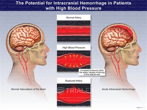 The Potential For Intracranial Hemorrhage In Patients With High B
