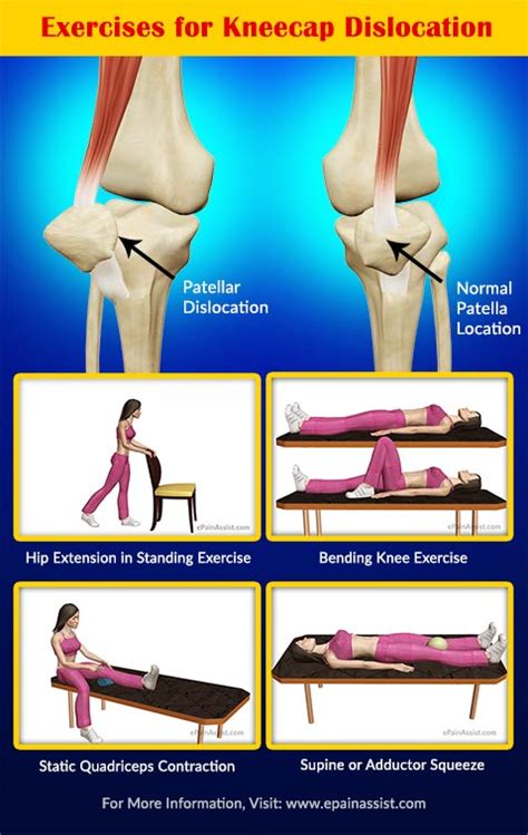 Recovery Exercises Prevention Of Kneecap Dislocation Or Patellar
