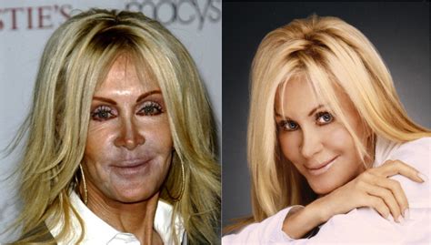Bad Plastic Surgery Before And After