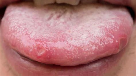Pimples On The Tongue How To Remove Them Step To Health