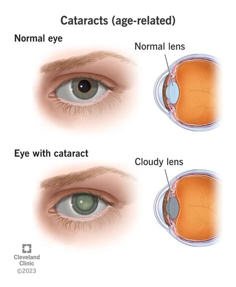 Cataracts Signs Symptoms And Treatment Options