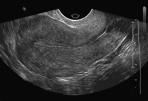 Female Pelvic Anatomy Ultrasound Normal Gynaecological Ultrasound Transvaginal Image