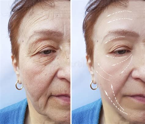 Old Woman Wrinkles Before And After Results Medicine Procedures Facial