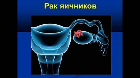 Рак яичников диета Рак яичников - YouTube Рак яичников - YouTube Рак яичников диета