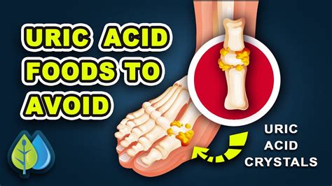 Top 10 Uric Acid Foods To Avoid Worst Uric Acid Foods For Gout Attacks Youtube