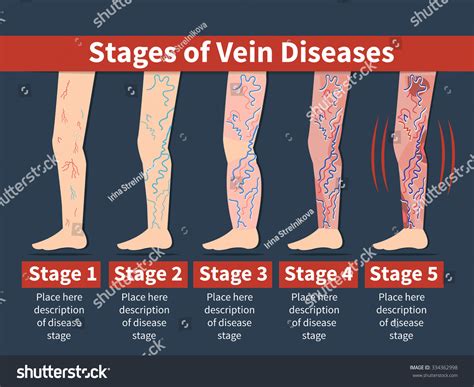 Vector Varicose Infographic Stage Vein Diseases เวกเตอร์สต็อก ปลอดค่า
