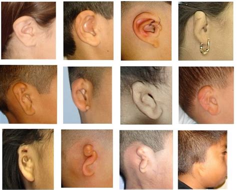 Microtia Ear Surgery And Bone Anchored Hearing Devices Sheryl Lewin